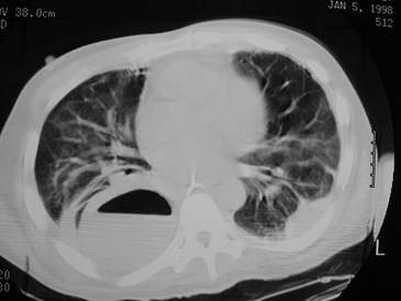 empyema bey CT lung 1 